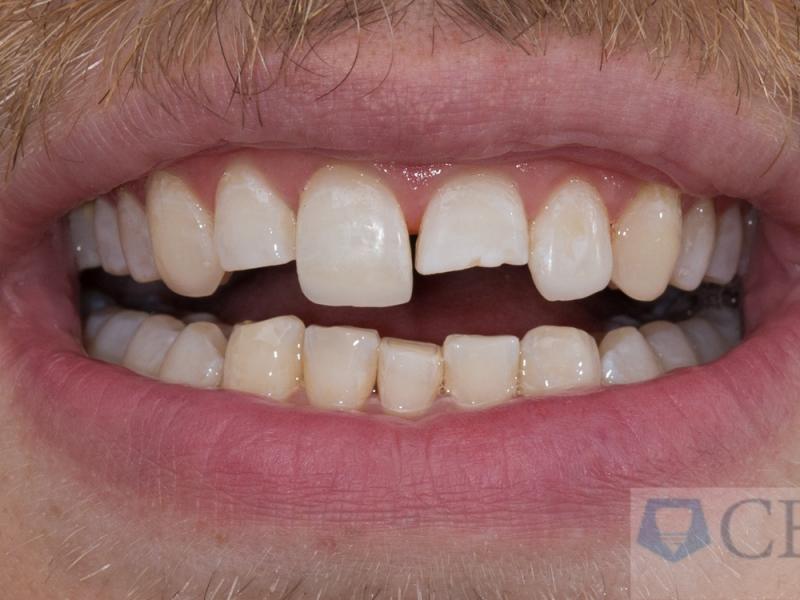 Välivaihe muovikorjauksessa, huomaa kuinka voimakkaan kuluneet omat hampaat ovat väärän purennan takia